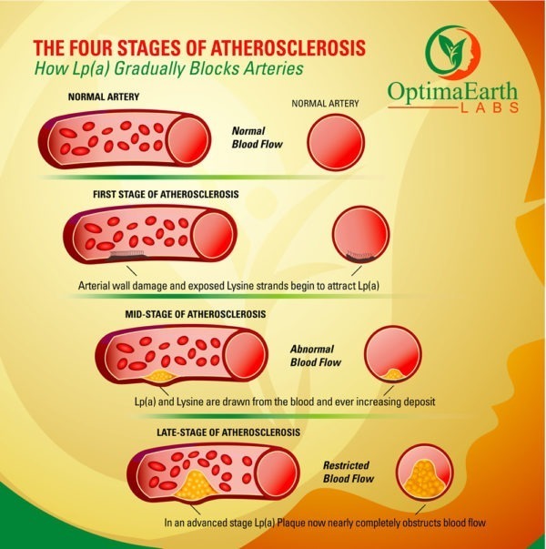 ATHEROSCLEROSIS INFOGRAPHIC STAGES